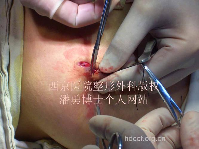乳头凹陷的整形手术全过程