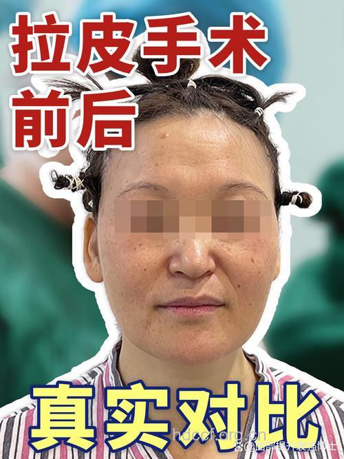 面部除皱术整形问题大全