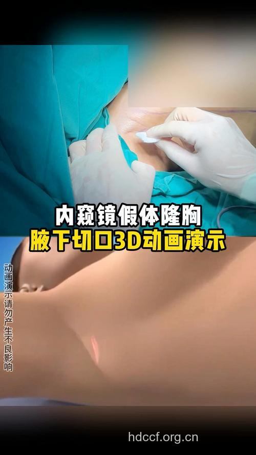 微创丰胸 为你定制完美乳房