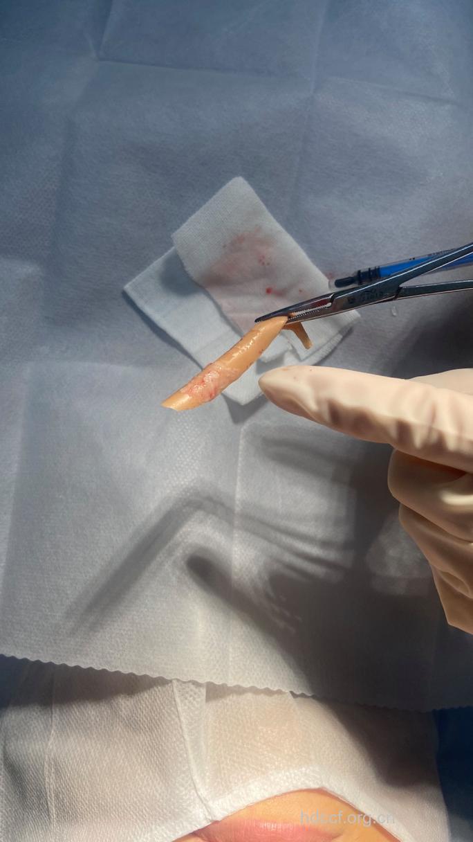 假体隆鼻 想拿出来就拿出来吗？