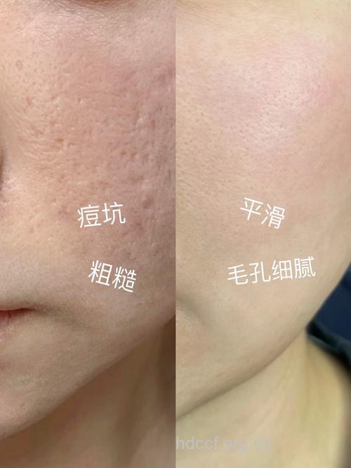 告别小痘坑 再现光嫩皮肤