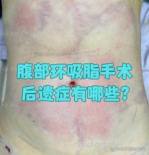 吸脂瘦身常见的并发症