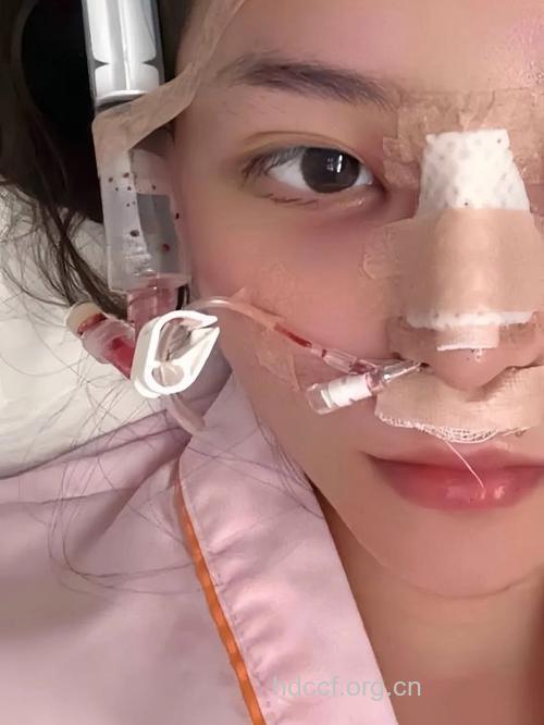 隆鼻术后切口的护理