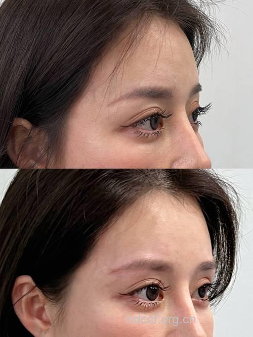 重塑丰眉弓 面部线条更完美