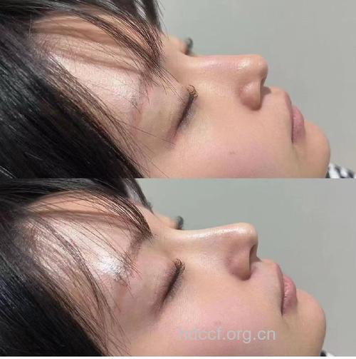 慎用液态硅胶注射隆鼻