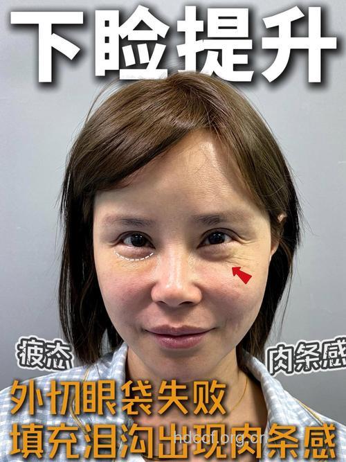 去眼袋整形失败了怎么办?
