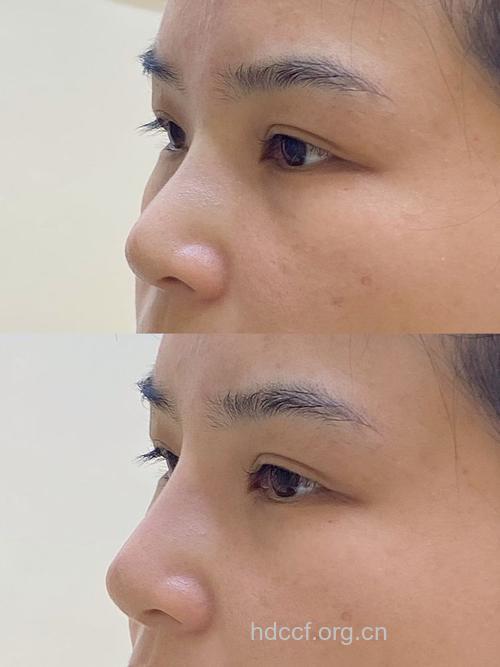 轻松用玻尿酸隆俏丽鼻