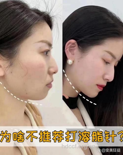 溶掉脂肪召回美丽