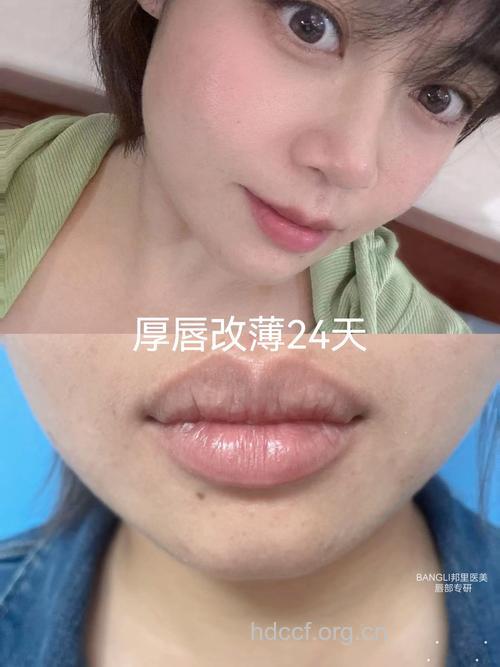 厚唇改薄手术
