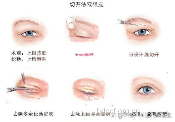 进行重睑手术有哪些常见问题