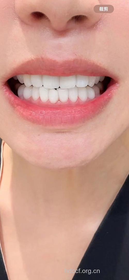 美齿，现在流行“烤瓷牙”