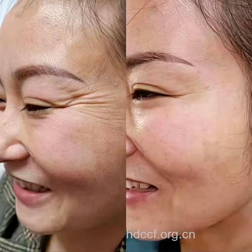 什么是脸部除皱术?