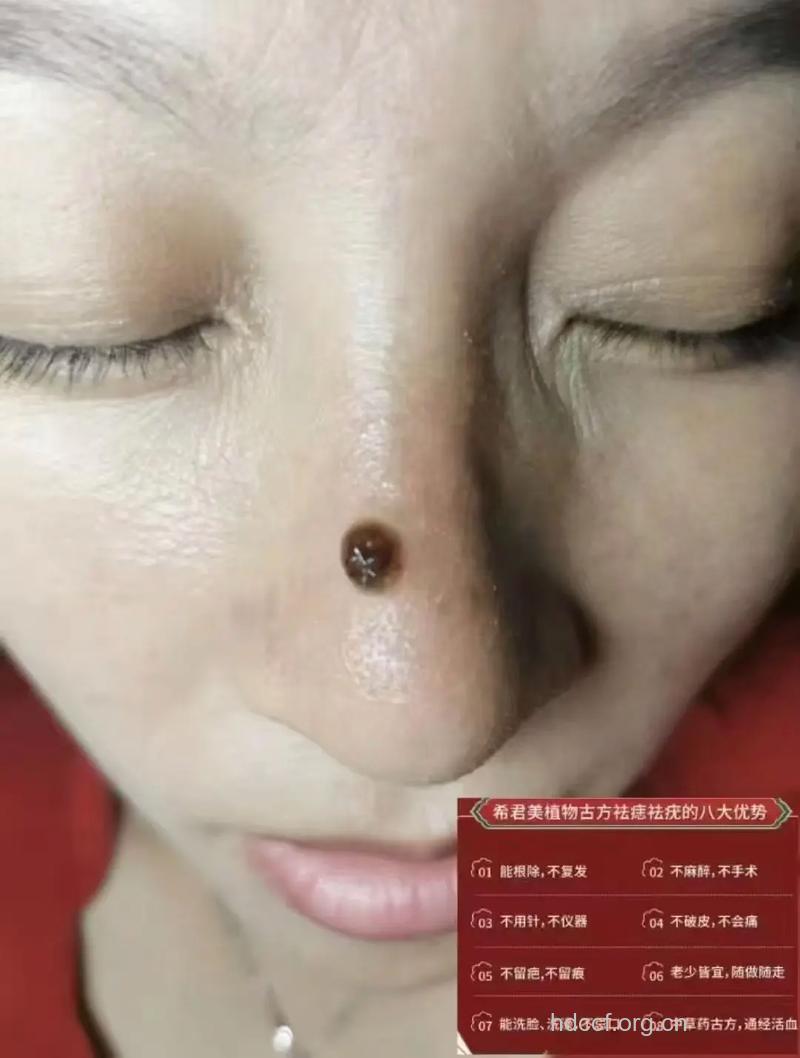 鼻上人造痣 整形新花样