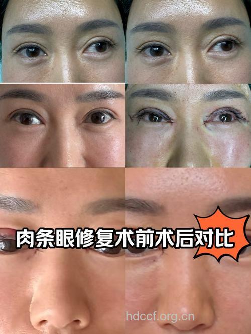 图解 双眼皮手术前后对比
