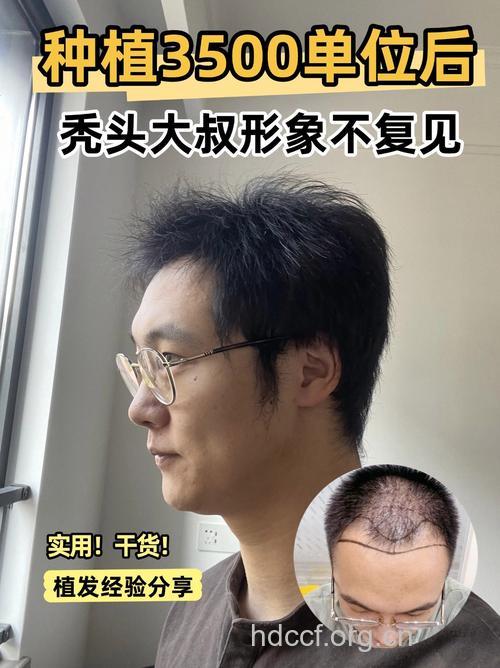 植发植的是什么头发 植发后还会脱发吗