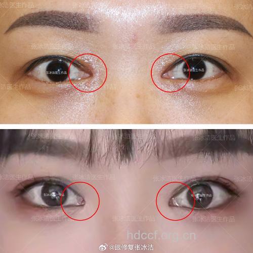 重睑失败有哪些修复方法