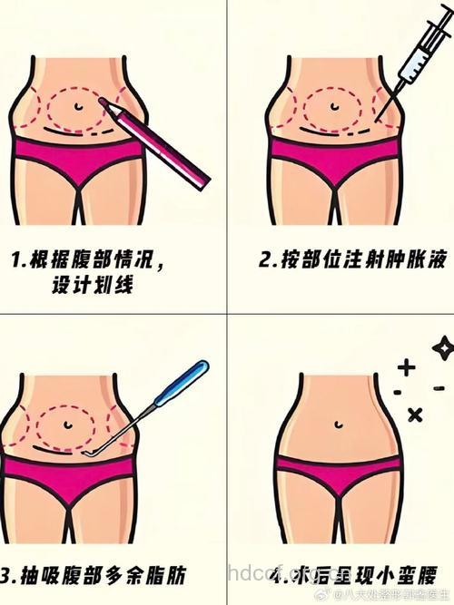 腹部吸脂后要注意什么 不能接触热源