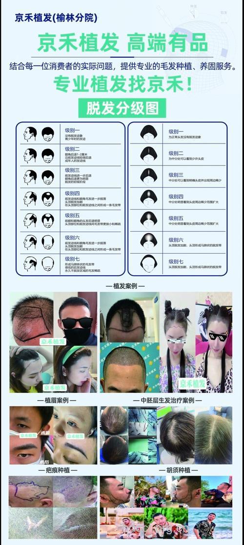 严重脱发需要植发吗？看个人选择