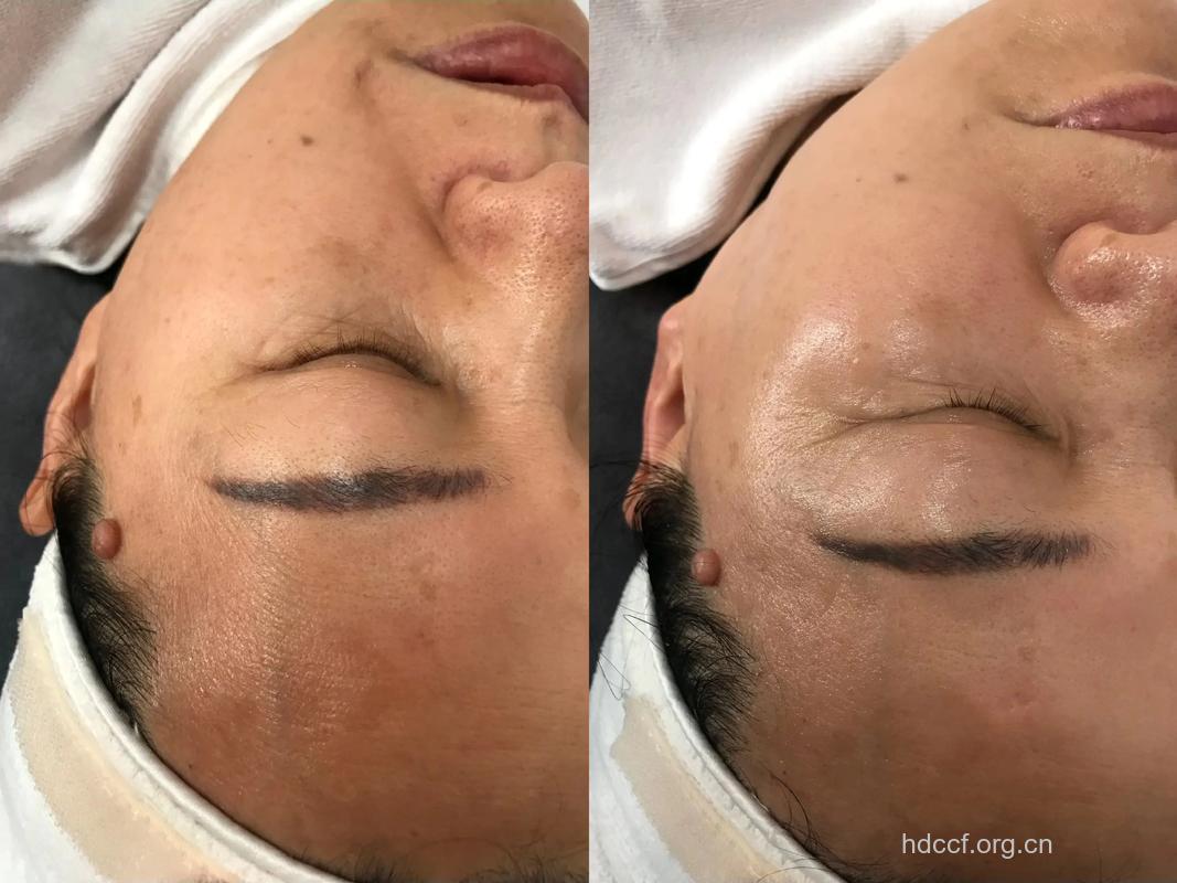 激光除皱术前术后做什么