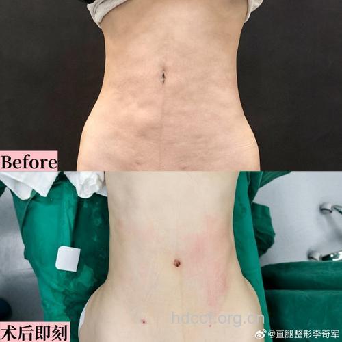 吸脂后皮肤不平整 可能是没穿塑形衣