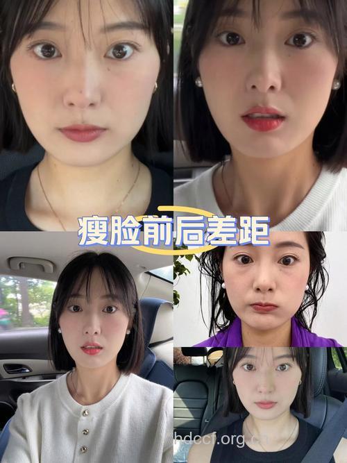 咬肌肥大就选瘦脸针 立马变成瓜子脸