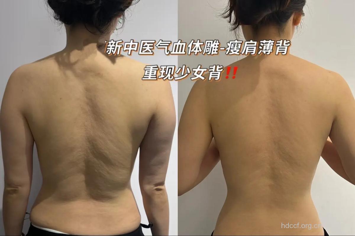 背部吸脂好吗 帮你甩掉多余赘肉