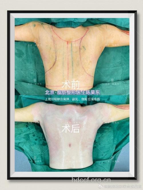 背部吸脂术会有副作用吗 易出现麻木感