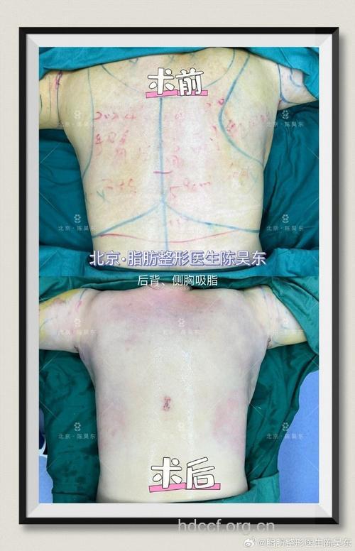 想快速拥有美背 就选择背部吸脂