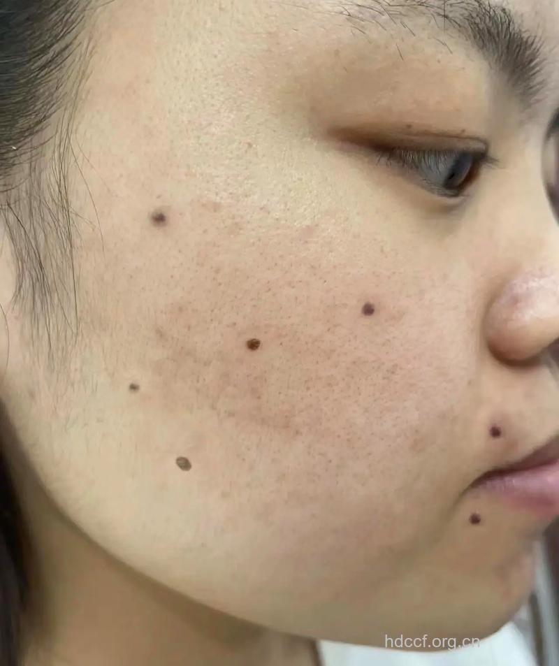 激光去黑色素效果如何 无痕见效快