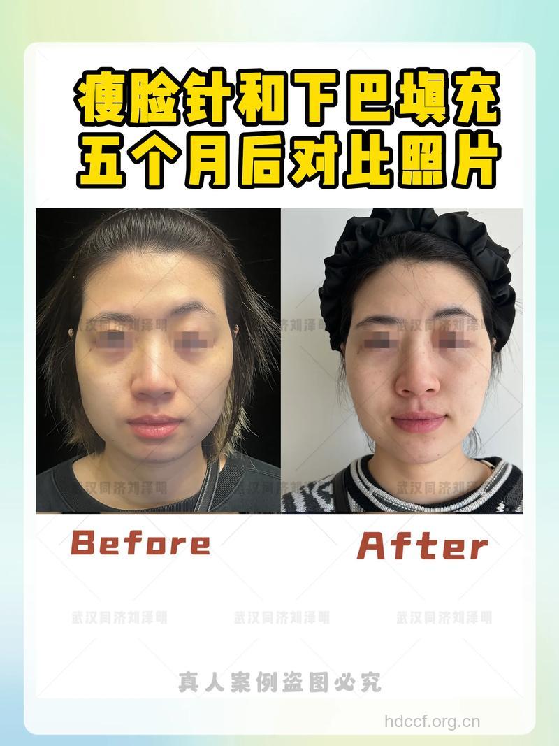 瘦脸针术后效果与五大因素相关