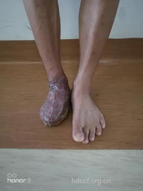 什么是“皮瓣预制”