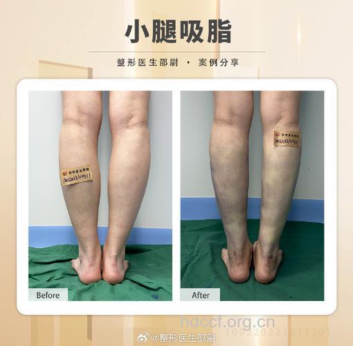 哪些人不适合做小腿吸脂术