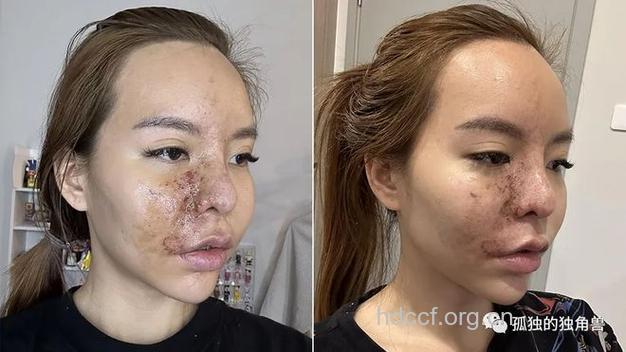 怎样避免整形变毁容