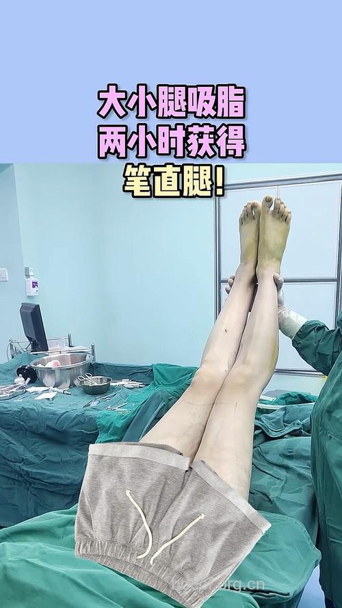 小腿吸脂术 塑造动人的美腿