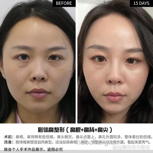 朝天鼻矫正效果如何