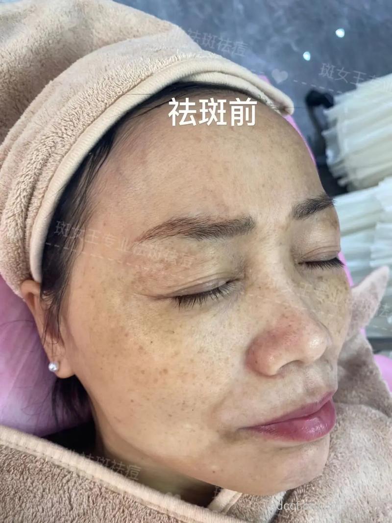 彩光祛斑效果怎么样?