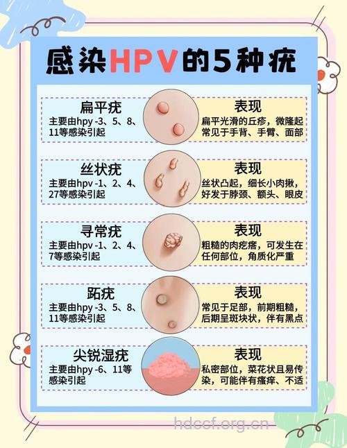 疣的发病因及治疗方法