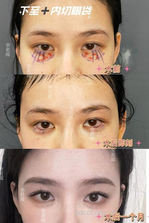 去眼袋手术有哪些特点