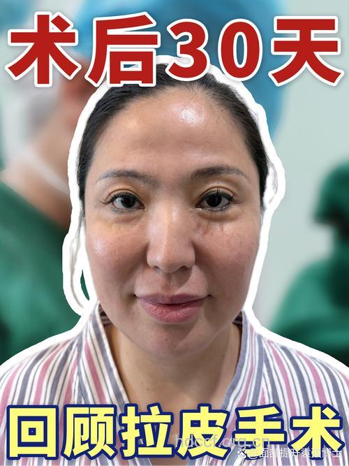 电波拉皮除皱效果好 术后护理是关键
