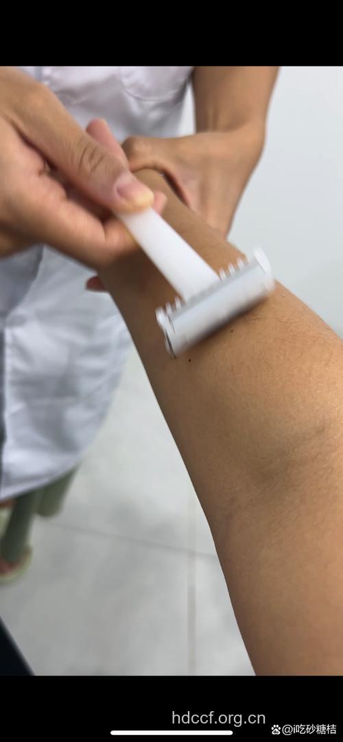 女性手臂如何脱毛 建议选择激光脱毛