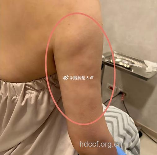 手臂吸脂会留疤吗 对身体有没有危害