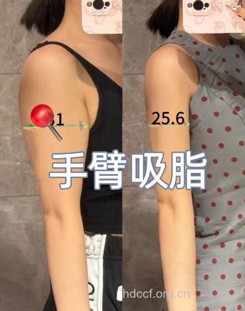 整容科普：上臂吸脂减肥会不会反弹