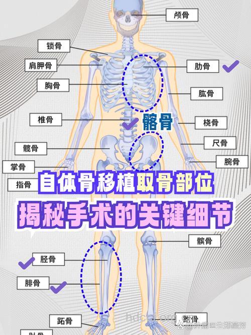 “人造骨”移植技术是怎样完成的呢