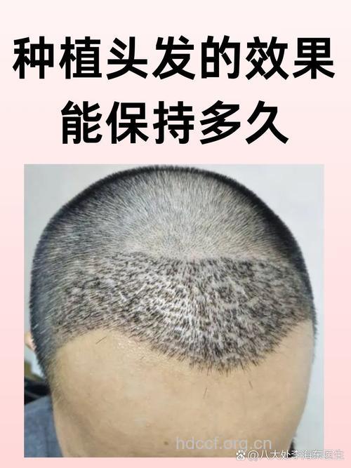 揭秘头发种植术 让你拥有浓密秀发