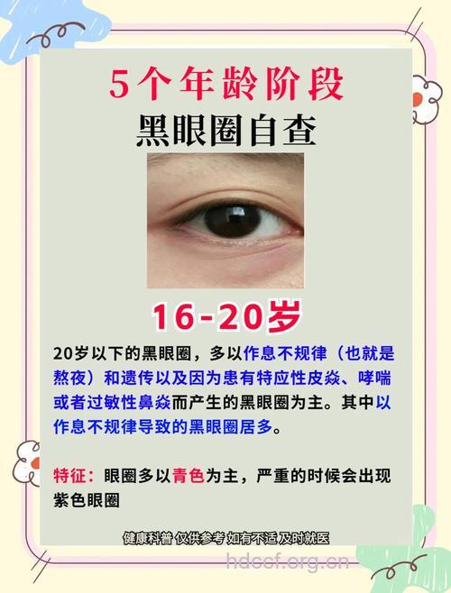 导致黑眼圈的4个疾病