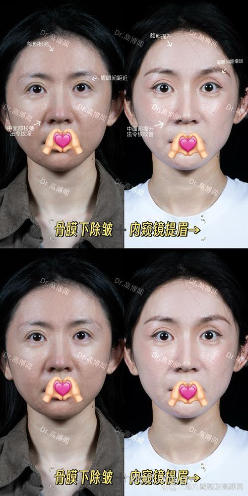 面部除皱术的术前术后