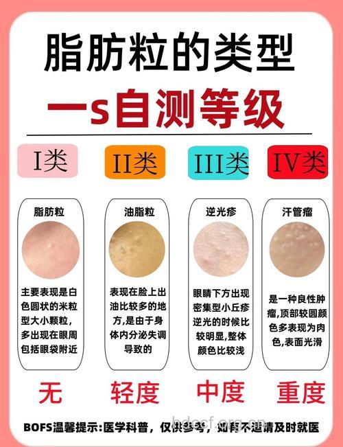 5个妙招去除脸上脂肪粒