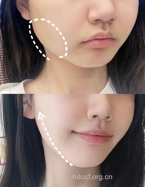 瘦脸针打对地方 才能变成精致瓜子脸