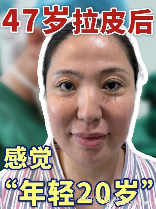 电波拉皮改善松弛皮肤 四种术后反应属正常