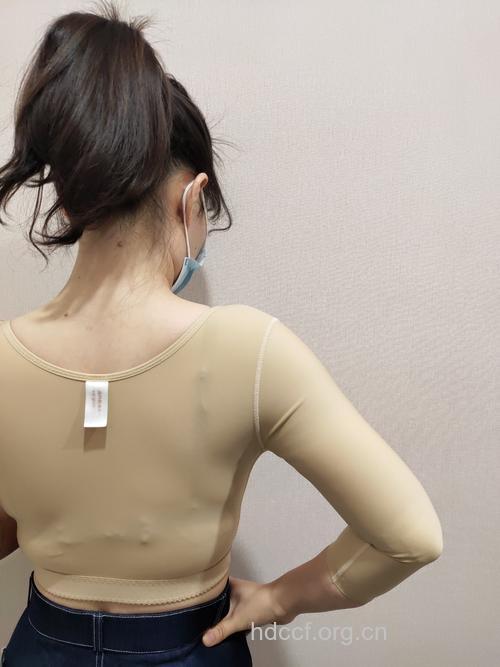 手臂吸脂效果好吗 能够帮你迅速瘦手臂